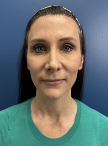 Brow Lift After Photo by Lisa Brostrom, MD; San Antonio, TX - Case 49852