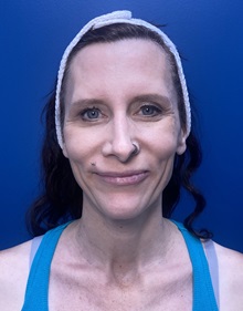 Brow Lift Before Photo by Lisa Brostrom, MD; San Antonio, TX - Case 49852