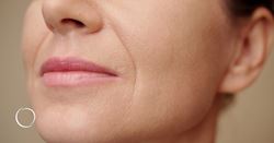 Understanding fat-based fillers: alloClae, Renuva, Lipoderma and more